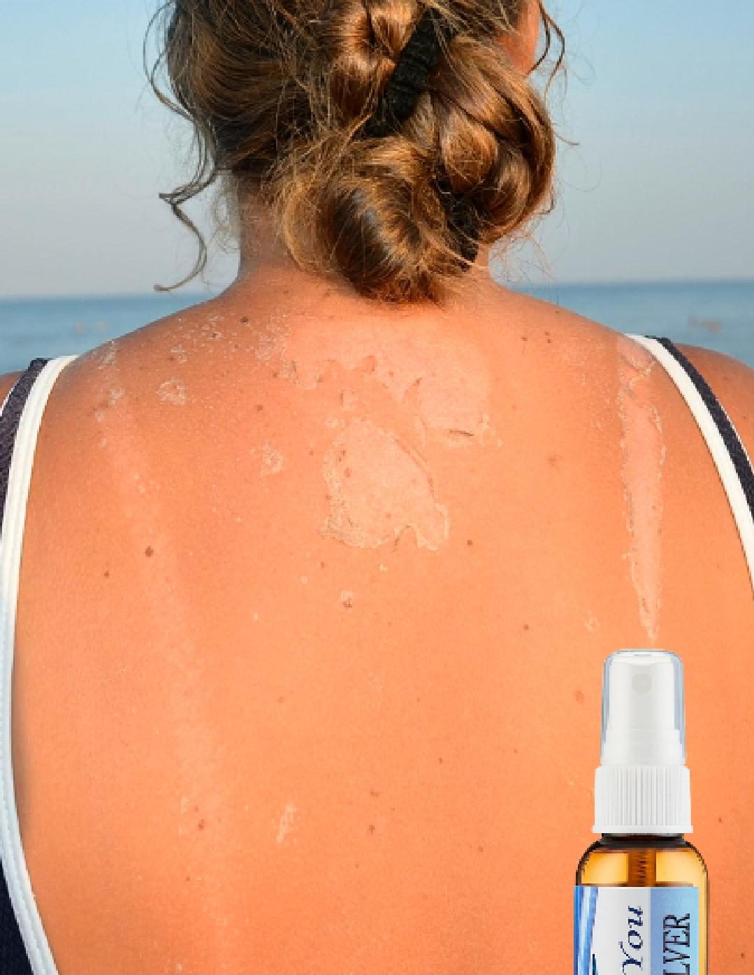 Sunburn Relief
