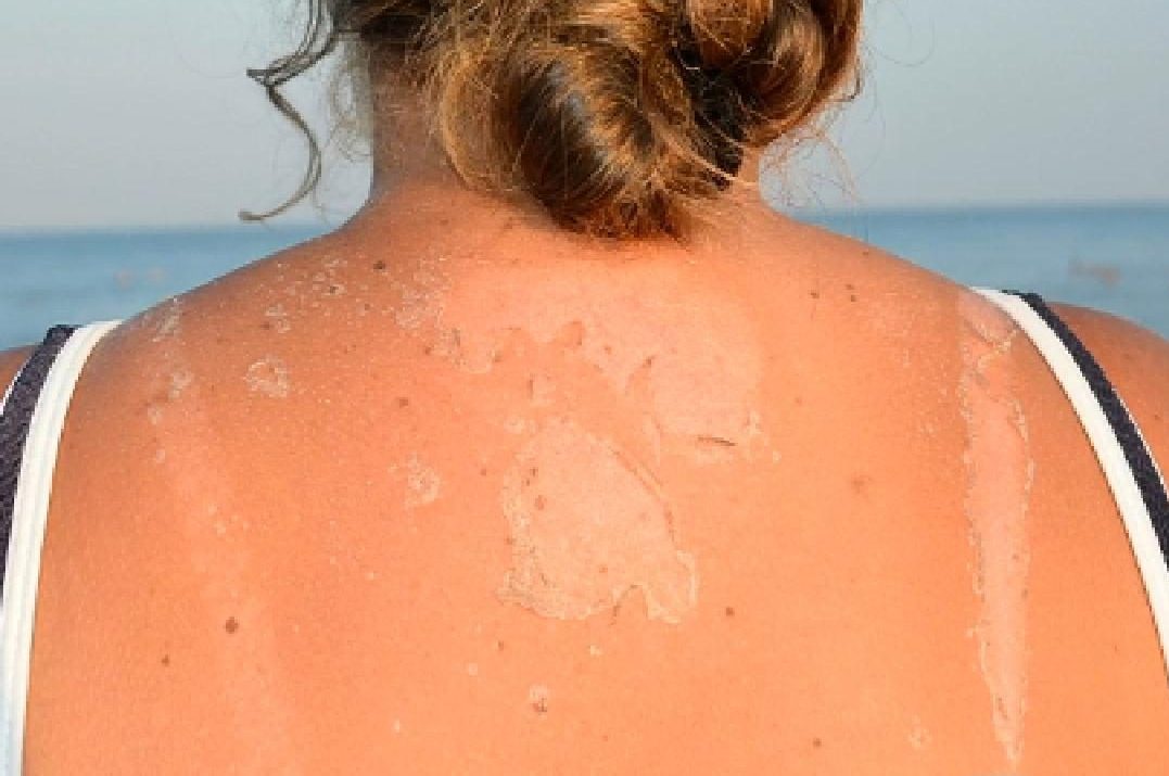 Sunburn Relief