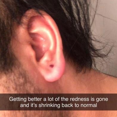 Infected Ear After Spraying with Optimum You Colloidal Silver