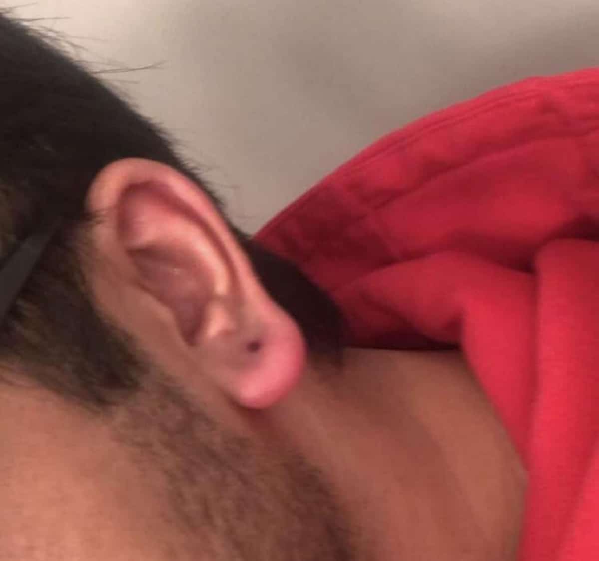 Infected Ear Before Spraying with Optimum You Colloidal Silver
